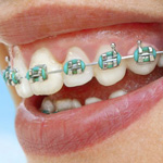 braces