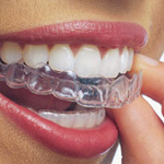 Invisalign